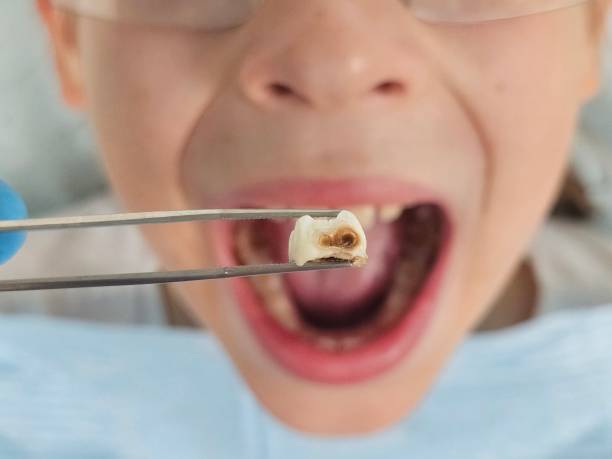 Best Emergency Wisdom Teeth Removal in Culpeper, VA